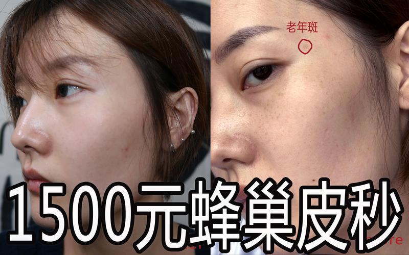 2026金昌蜂巢皮秒价格参考与正规医院推荐指南