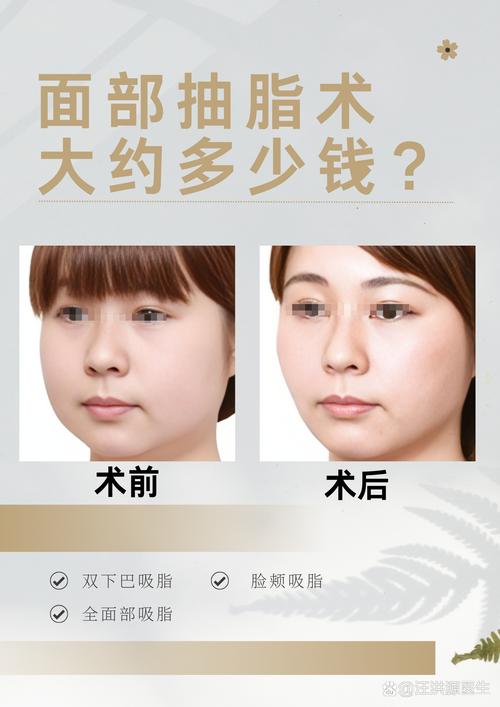 2026泰安面部吸脂排行榜前十强盘点：价格、口碑及避坑指南