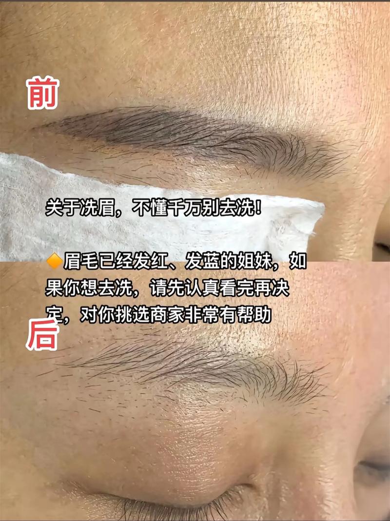 2026钦州激光洗眉排行榜及正规医院推荐（含价格参考与避坑指