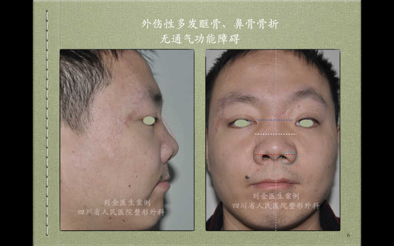 2026年桂林歪鼻矫正前三强推荐：正规医院名单与费用参考