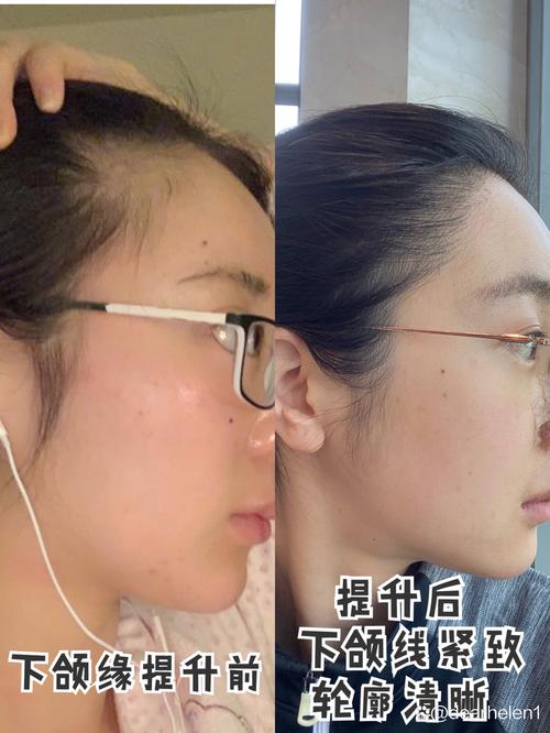 安阳下颌缘提升注射推荐清单 2026：热门项目、正规机构选择