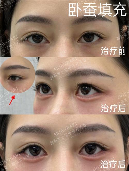 许昌卧蚕整形哪里好？2026正规医院推荐与费用价格表分析