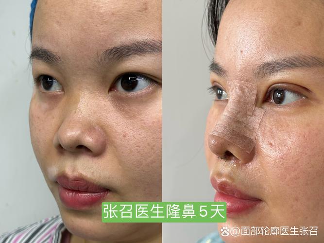 2026喀什隆鼻前十强榜单:正规医院价格、口碑及手术方式深度