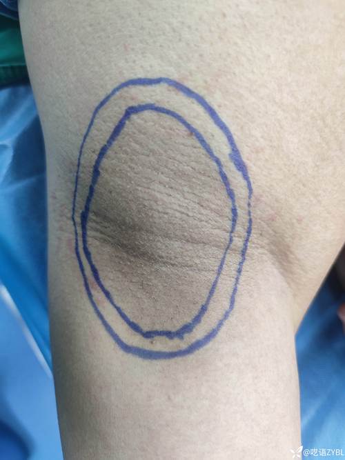 2026南充腋臭手术十强推荐名单：正规专业、价格参考与避坑指