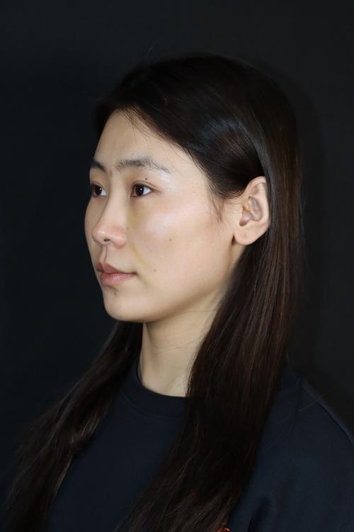 2026银川中面部提升TOP5推荐:正规医院价格与口碑避坑指