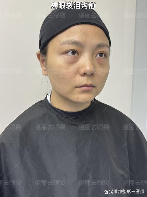 2026宁德眼袋手术价格参考与正规医美机构推荐
