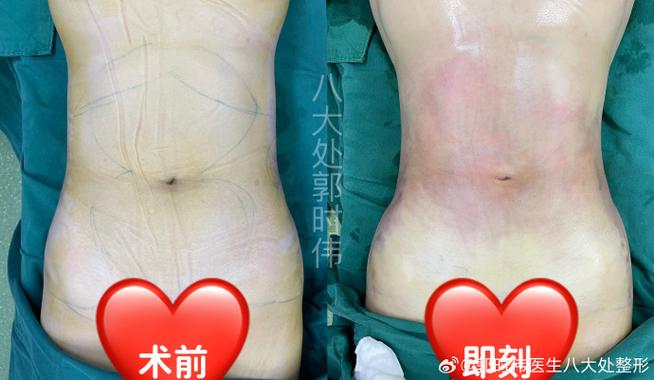 2026中卫腰腹吸脂哪家好？正规医院推荐、价格表及避坑指南