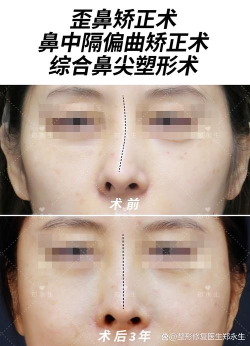 2026衡水歪鼻矫正口碑前五强推荐：正规机构名单与费用大盘点