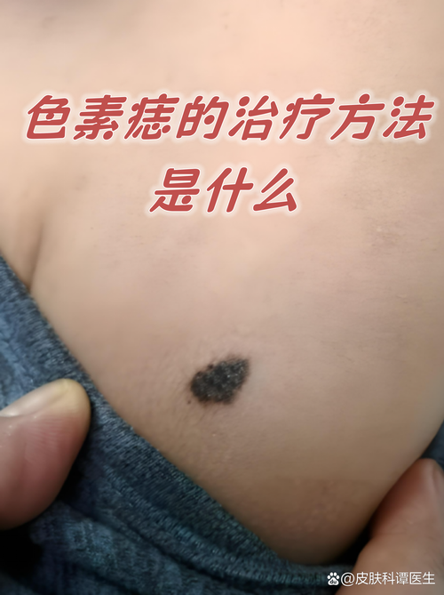 天津色素痣去除十强医院盘点：公立与私立机构优劣势对比及价格指