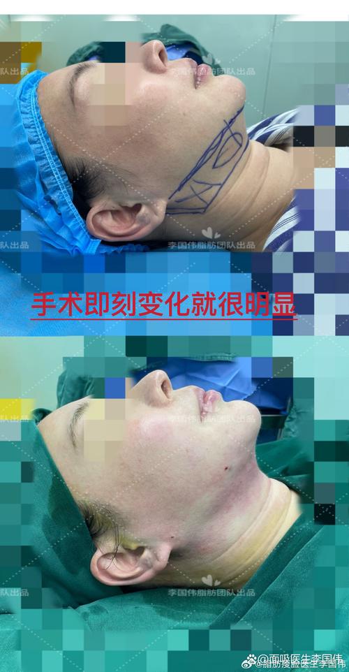 2026大连吸脂修复推荐：正规医院怎么选？避坑指南与费用解析