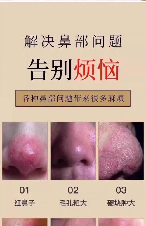 2026雅安酒糟鼻治疗指南:正规医院推荐与价格解析
