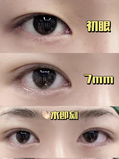 2026吕梁三点双眼皮专业推荐：正规医院十强榜单与价格参考