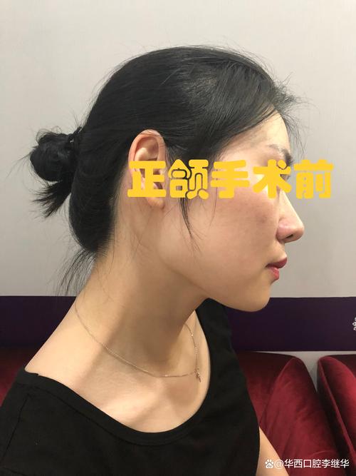 2026伊春磨骨整形盘点：正规医院推荐与价格避坑指南