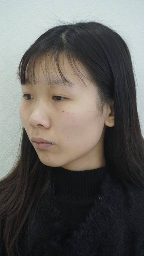 三明玻尿酸隆鼻2026：正规医院推荐与价格避坑指南
