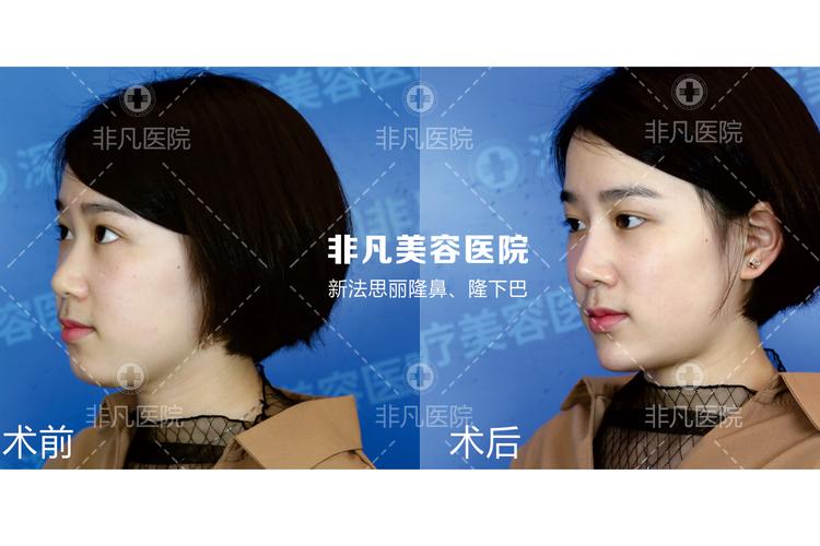 遂宁玻尿酸丰下巴正规医院推荐 2026口碑排名与价格参考