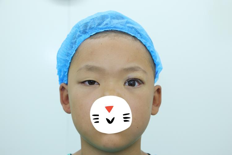 吉林眼睑外翻矫正前3强：正规医院推荐与价格参考