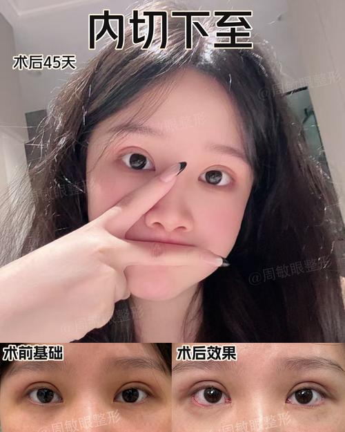 南宁下眼睑下至怎么选？2026年正规医院推荐与价格避坑指南