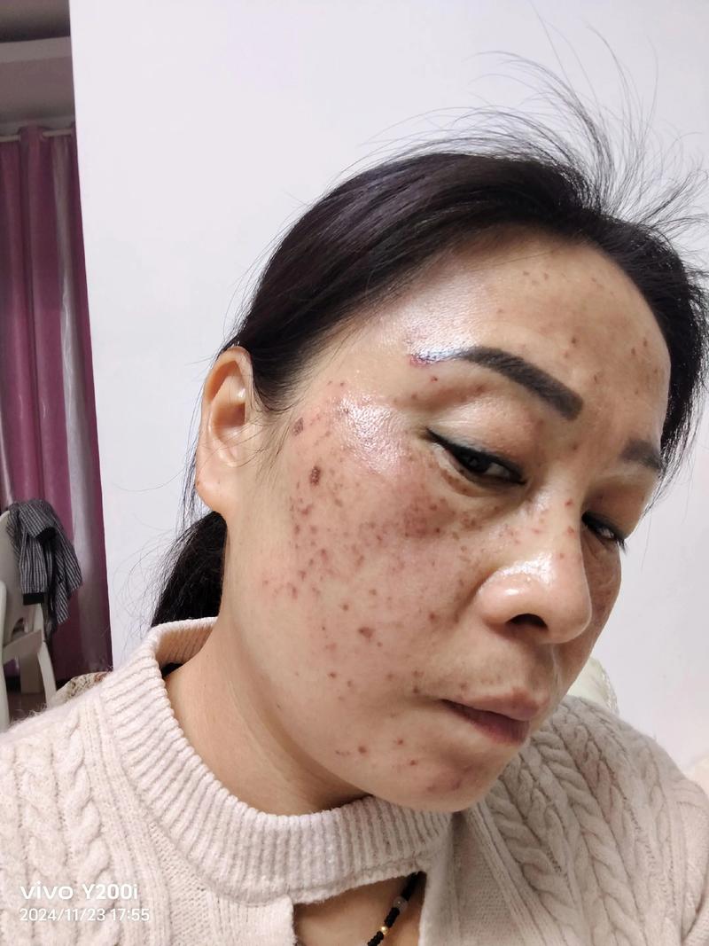 邯郸激光祛晒斑正规医院推荐TOP3:2026口碑价格及避坑指