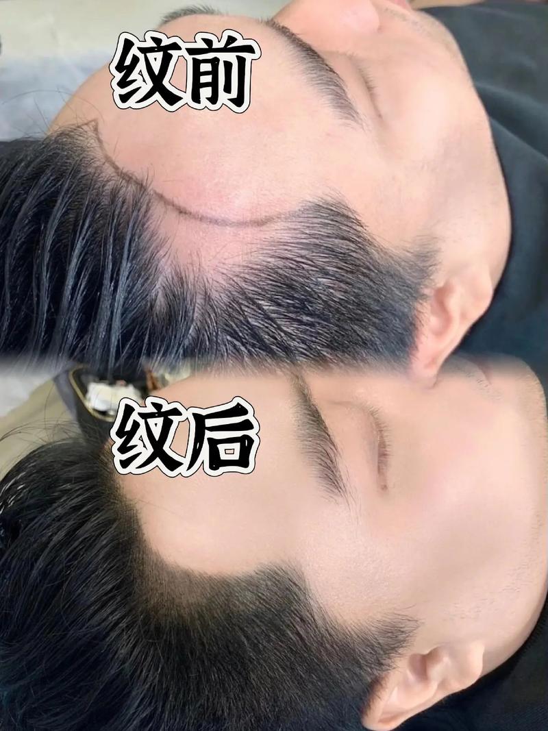 2026厦门发际线半永久TOP5专业机构推荐:正规医院与价格 2026厦门发际线半永久TOP5专业机构推荐:正规医院与价格