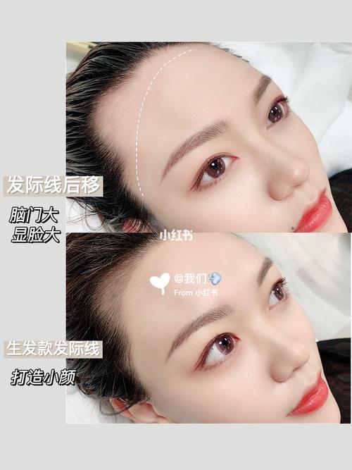 2026厦门发际线半永久TOP5专业机构推荐:正规医院与价格