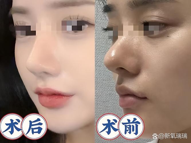 安顺鼻小柱延长正规医院排行榜：2026年价格参考与避坑指南