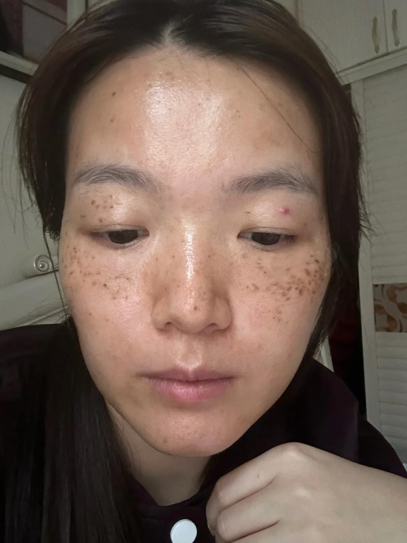 广安激光祛斑正规医院价格表2026版推荐，正规机构十大排行名