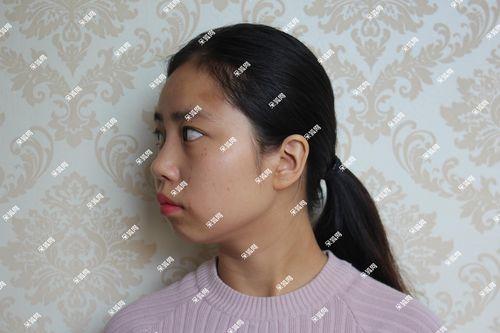 2026三明隆下巴正规医院推荐：价格对比、技术解析与避坑指南