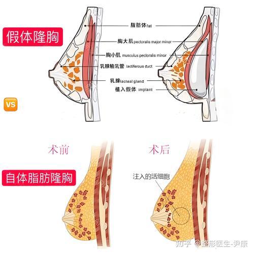 牡丹江假体隆胸盘点2026：正规机构TOP3推荐与价格避坑指