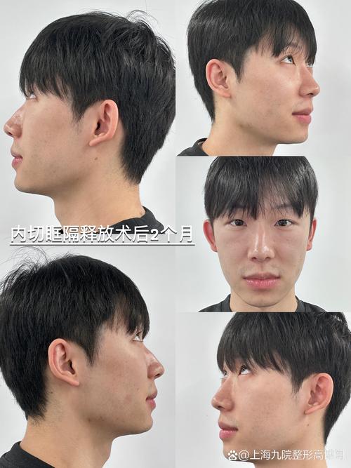 黄冈眶隔脂肪释放哪家好?2026年正规医院价格与口碑前3强推