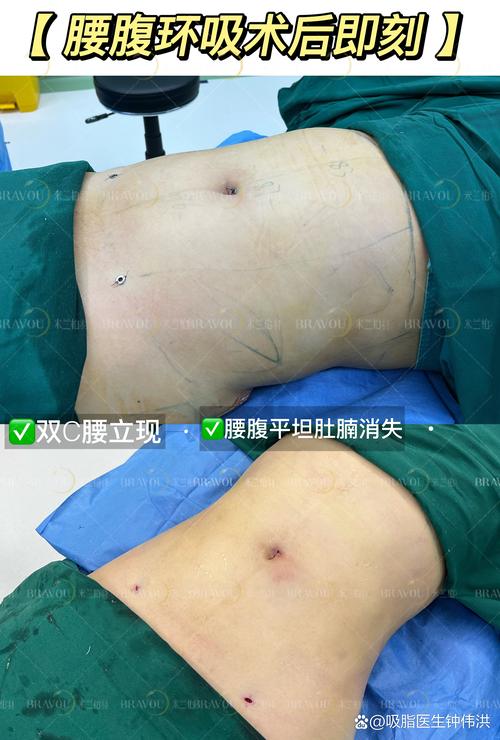 德州腰腹吸脂前3强推荐：2026年正规医院价格与口碑对比分析