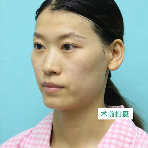 2026年锡林郭勒全面部脂肪填充哪家强?正规机构推荐与避坑指