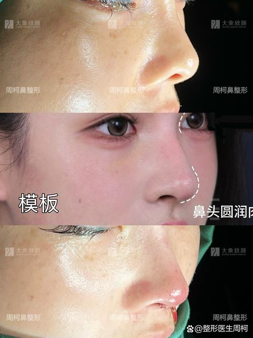 2026济南假体隆鼻口碑与避坑指南：正规医院及价格全解析