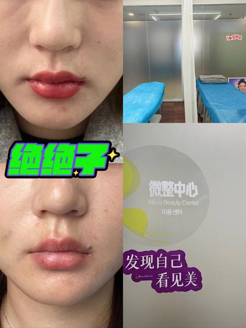 2026邵阳玻尿酸填充鼻基底避坑指南:正规医院推荐、价格参考