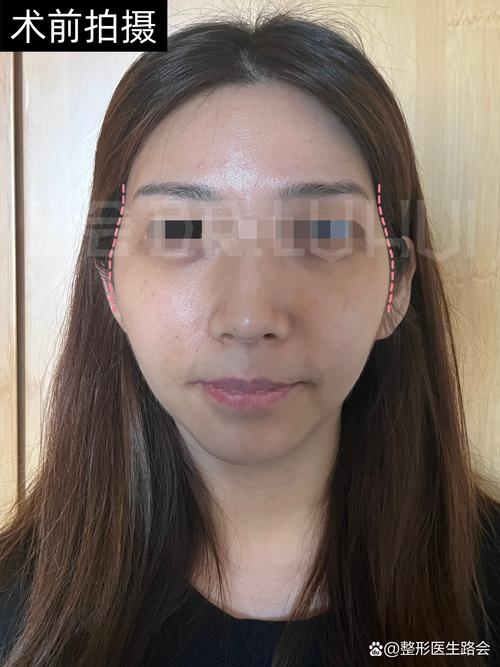 莆田自体脂肪丰太阳穴医院排行榜2026:正规机构推荐、费用解