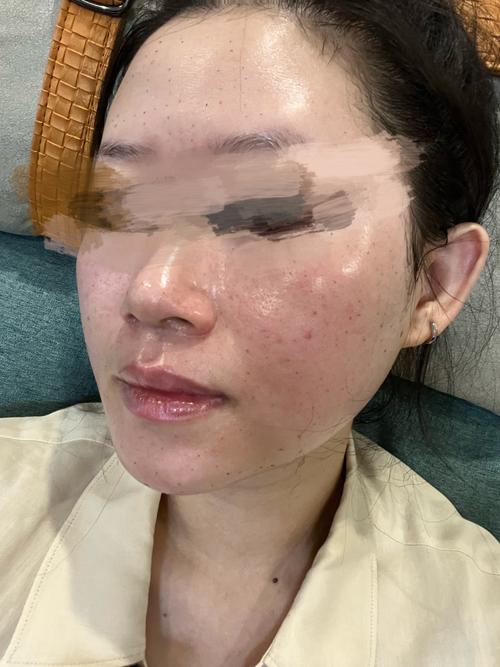 滁州水杨酸焕肤怎么选?2026正规医院推荐与避坑指南