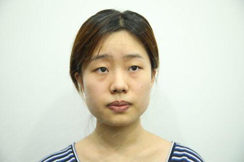 2026阳泉自体脂肪丰苹果肌前5名推荐：正规机构名单与价格参