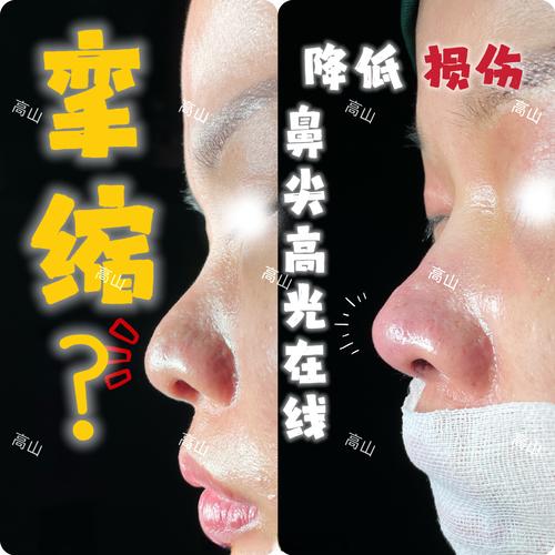 南阳鼻尖整形费用全解析：2026年正规机构推荐与避坑指南