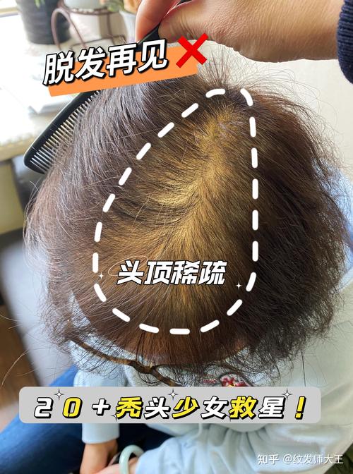 锡林郭勒头顶加密医院排行榜:2026正规机构推荐与价格解析 锡林郭勒头顶加密医院排行榜:2026正规机构推荐与价格解析