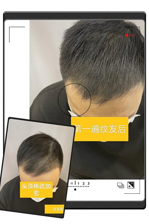 锡林郭勒头顶加密医院排行榜:2026正规机构推荐与价格解析 锡林郭勒头顶加密医院排行榜:2026正规机构推荐与价格解析