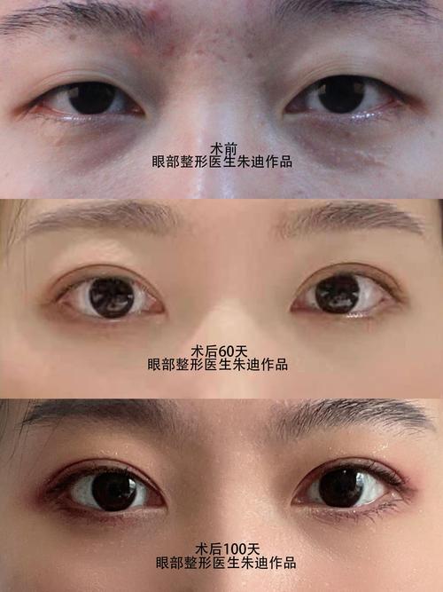 吴忠开内眼角手术费用详解:2026年价格趋势与正规机构推荐