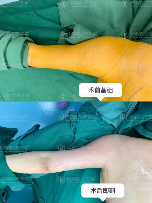 宁德手臂吸脂正规医院推荐:2025口碑排名前5名单与价格参考