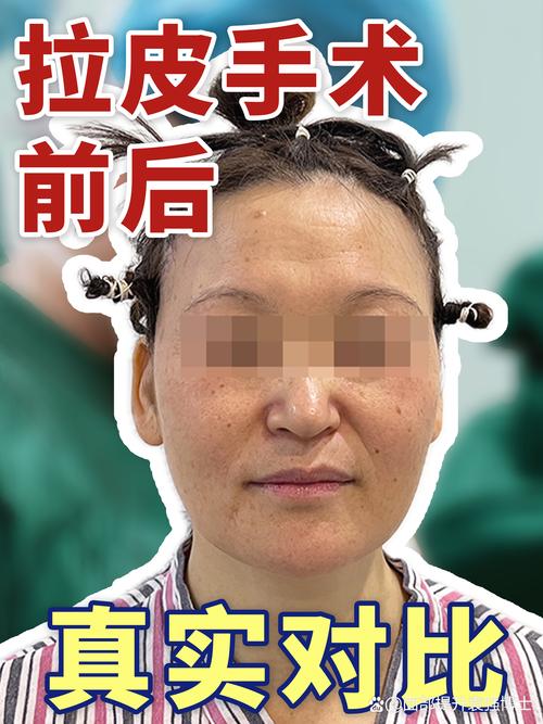 2026年铁岭拉皮手术前五名推荐:价格、技术与避坑全攻略