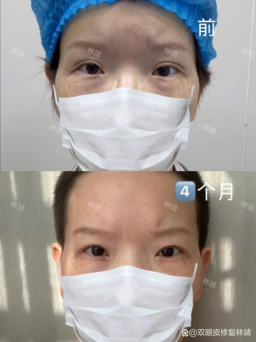 德阳切开双眼皮前3强大盘点：2026年口碑价格及正规机构推荐