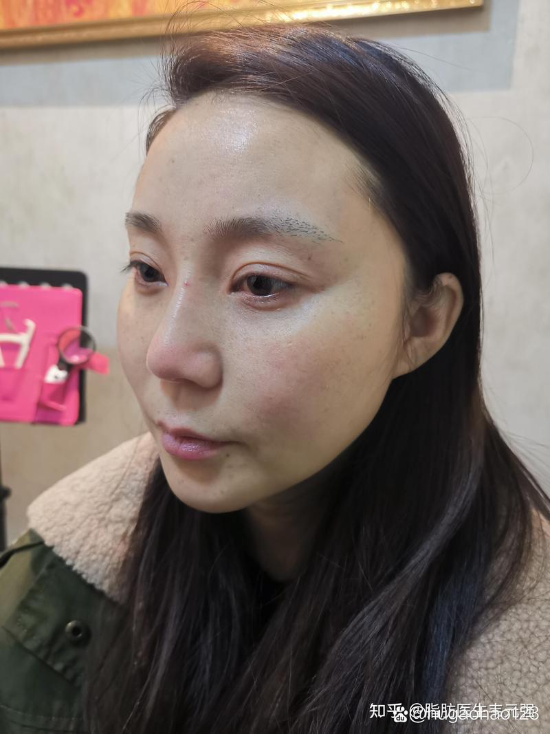 2026沧州自体脂肪丰苹果肌费用全解析:正规机构推荐与价格避