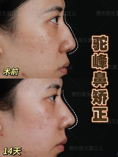 2026钦州驼峰鼻矫正多少钱？正规医院TOP3推荐与选院避坑