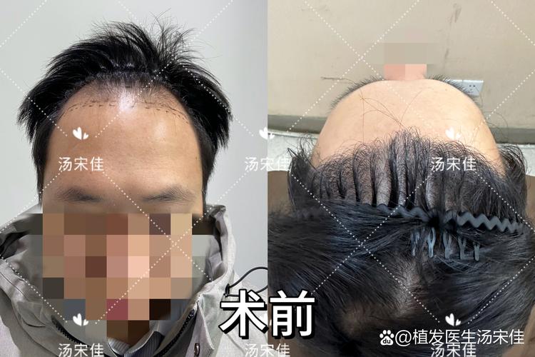 乐山发际线种植排行2026：前5强正规医院推荐与避坑指南