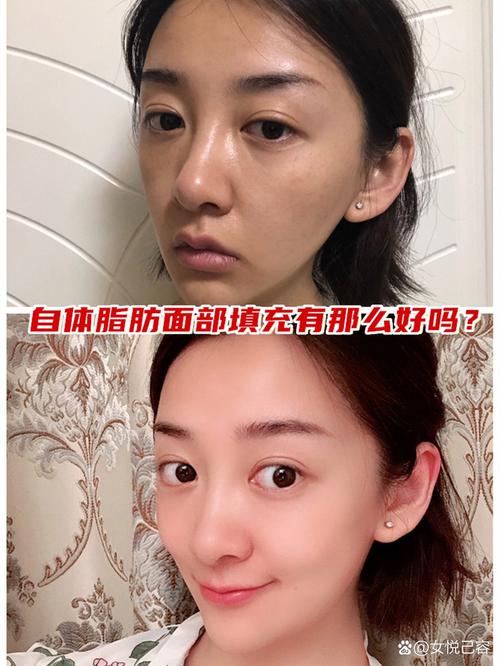 宜宾自体脂肪丰苹果肌口碑推荐：2026年正规医院排名及价格参