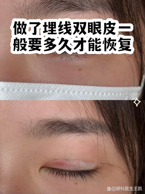 2026抚州埋线双眼皮前3强推荐，正规医院名单与价格避坑指南