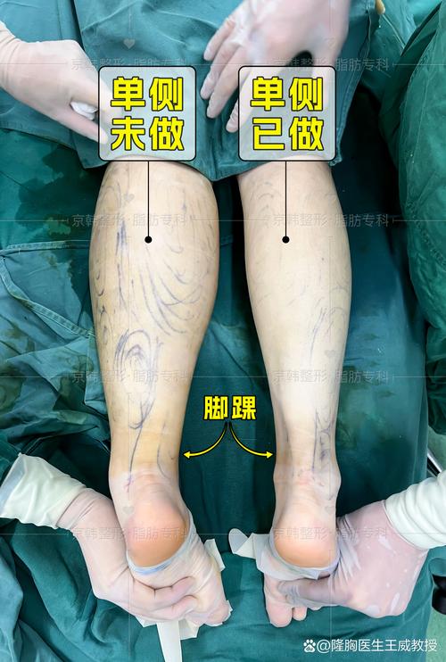 漳州小腿吸脂价格表2026：正规医院费用排名与避坑指南