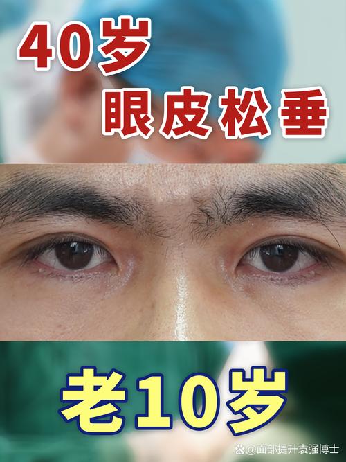 2026年巴音郭楞眼睑松弛修复TOP5盘点：价格、口碑与避坑